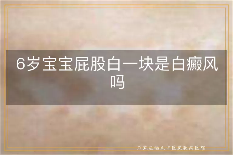 6岁宝宝屁股白一块是白癜风吗