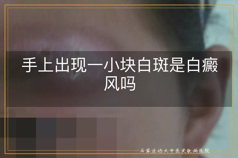 手上出现一小块白斑是白癜风吗
