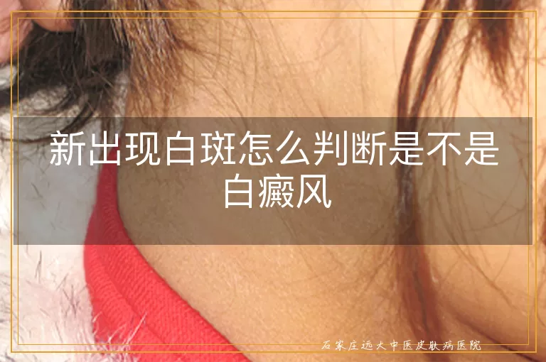 新出现白斑怎么判断是不是白癜风