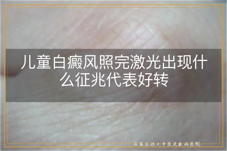 儿童白癜风照完激光出现什么征兆代表好转