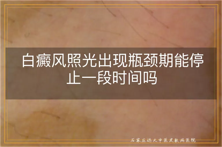 白癜风照光出现瓶颈期能停止一段时间吗