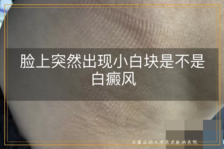 脸上突然出现小白块是不是白癜风
