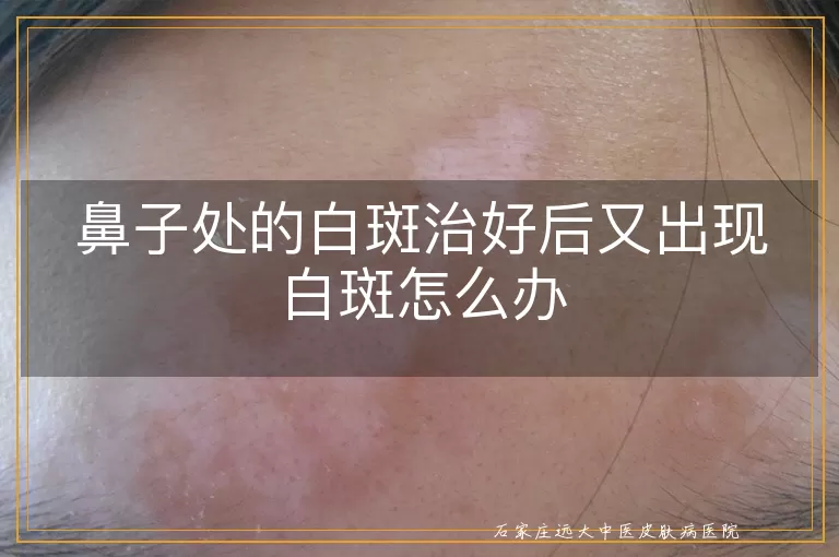 鼻子处的白斑治好后又出现白斑怎么办