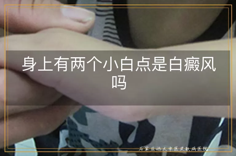 身上有两个小白点是白癜风吗