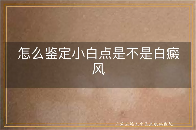 怎么鉴定小白点是不是白癜风