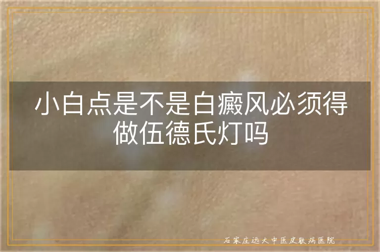 小白点是不是白癜风必须得做伍德氏灯吗