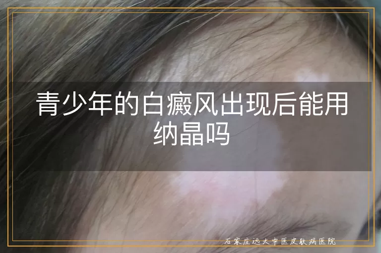 青少年的白癜风出现后能用纳晶吗