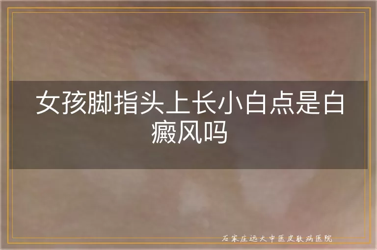 女孩脚指头上长小白点是白癜风吗