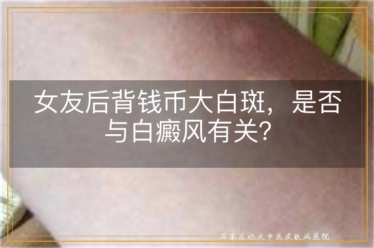 女友后背钱币大白斑，是否与白癜风有关？