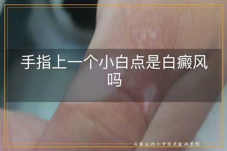 手指上一个小白点是白癜风吗