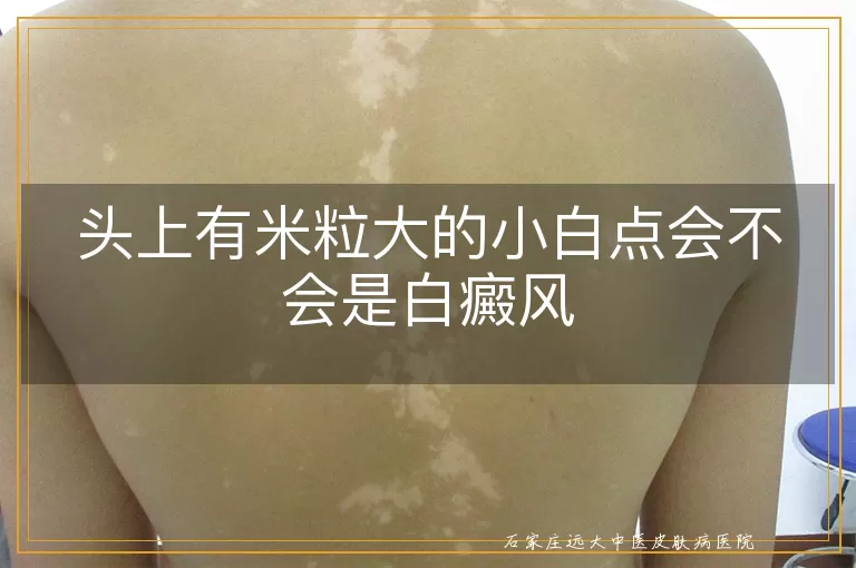 头上有米粒大的小白点会不会是白癜风