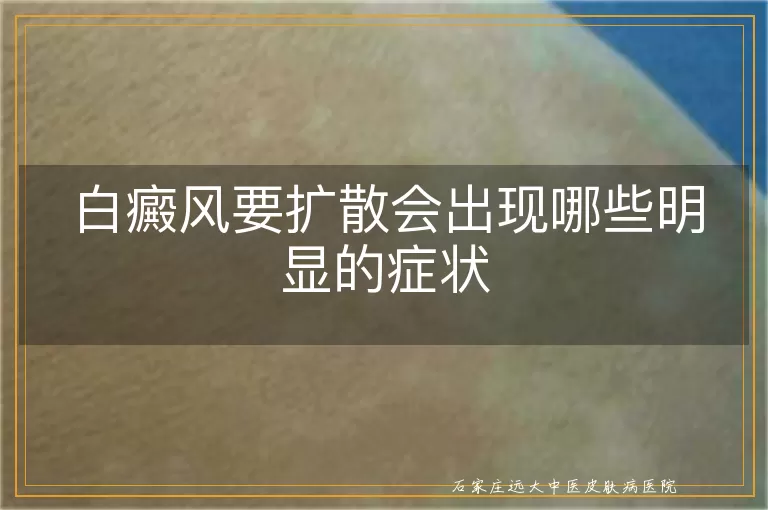 白癜风要扩散会出现哪些明显的症状