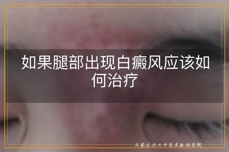 如果腿部出现白癜风应该如何治疗