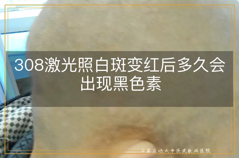 308激光照白斑变红后多久会出现黑色素