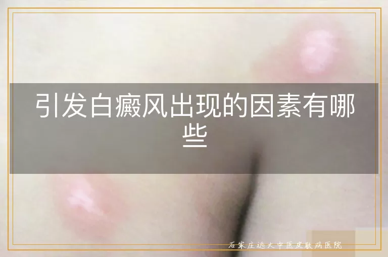 引发白癜风出现的因素有哪些