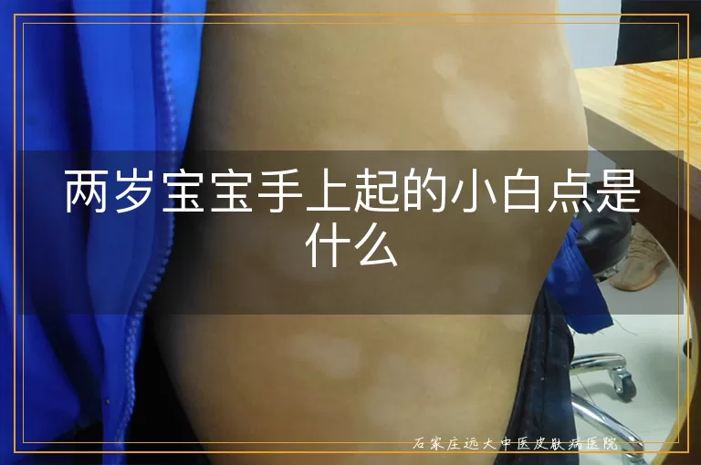 两岁宝宝手上起的小白点是什么