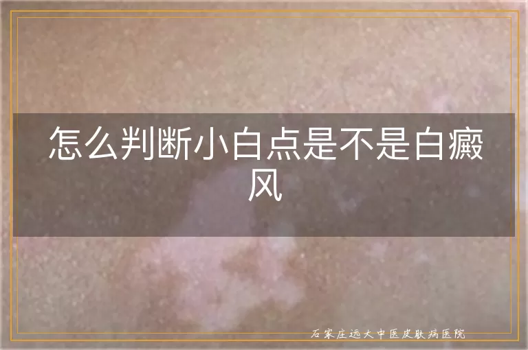 怎么判断小白点是不是白癜风