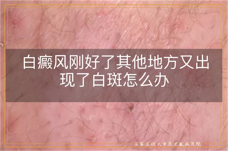 白癜风刚好了其他地方又出现了白斑怎么办