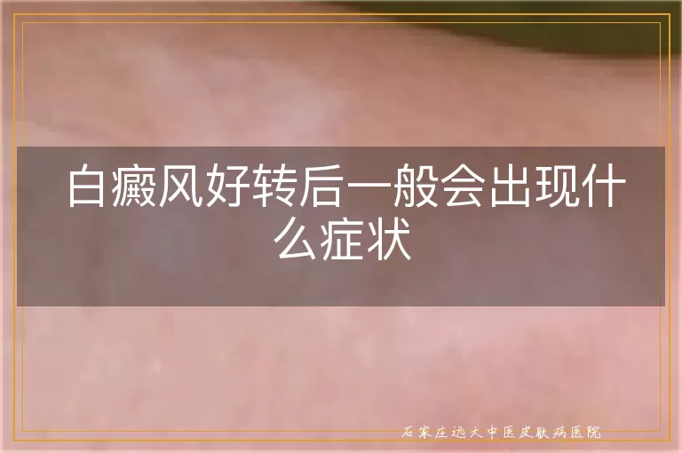 白癜风好转后一般会出现什么症状