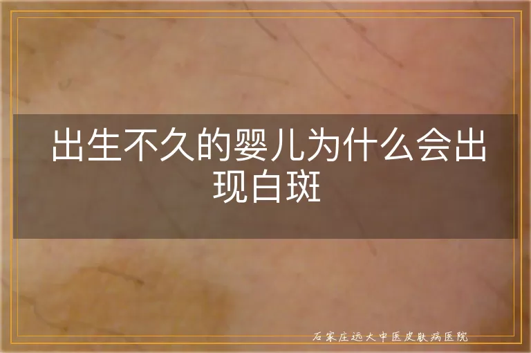出生不久的婴儿为什么会出现白斑