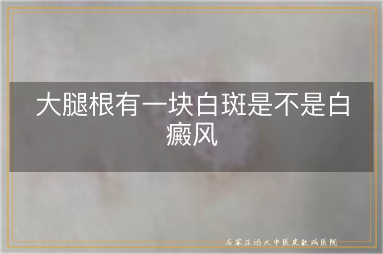 大腿根有一块白斑是不是白癜风