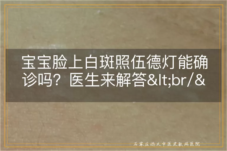 宝宝脸上白斑照伍德灯能确诊吗？医生来解答<br/>