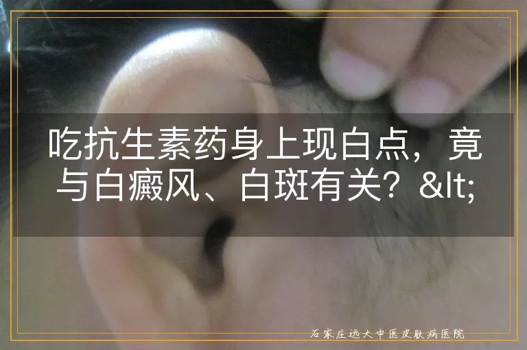 吃抗生素药身上现白点，竟与白癜风、白斑有关？<br/>