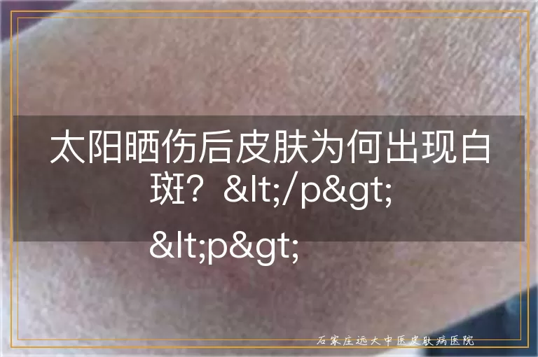 太阳晒伤后皮肤为何出现白斑？</p>
<p>