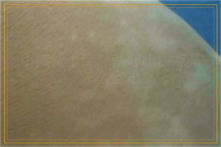 小孩背上突然就起小白点是怎么回事