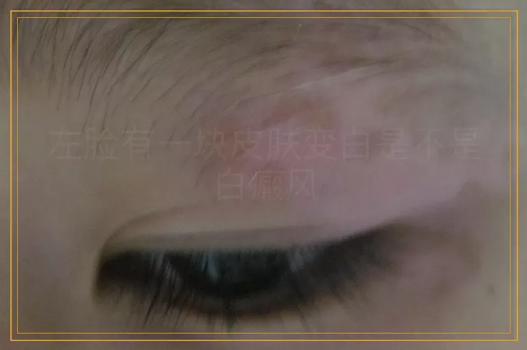 左脸有一块皮肤变白是不是白癜风