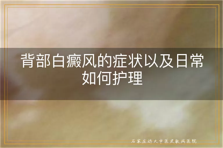 背部白癜风的症状以及日常如何护理