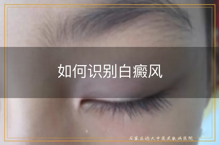 如何识别白癜风