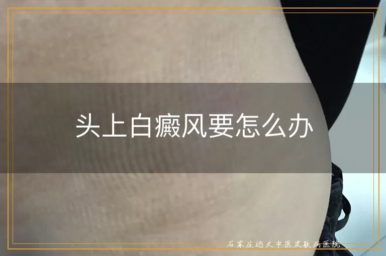 头上白癜风要怎么办