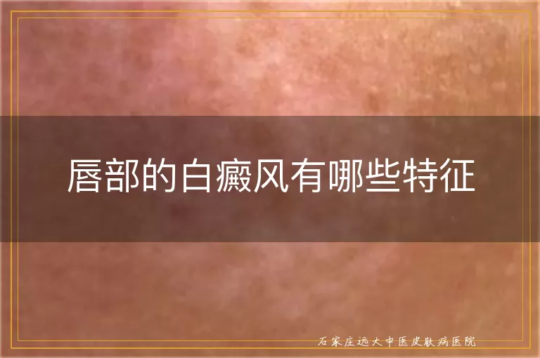 唇部的白癜风有哪些特征