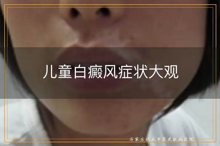 儿童白癜风症状大观