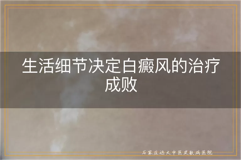 生活细节决定白癜风的治疗成败