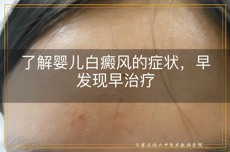 了解婴儿白癜风的症状，早发现早治疗