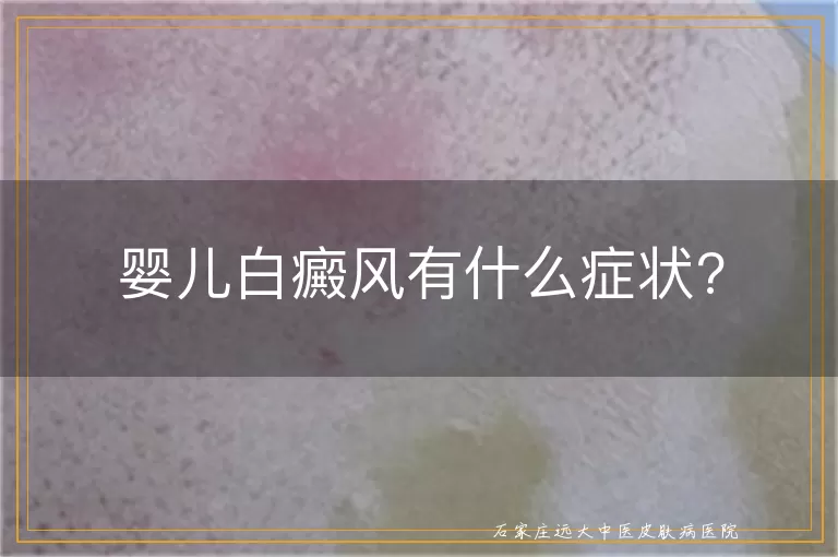 婴儿白癜风有什么症状?