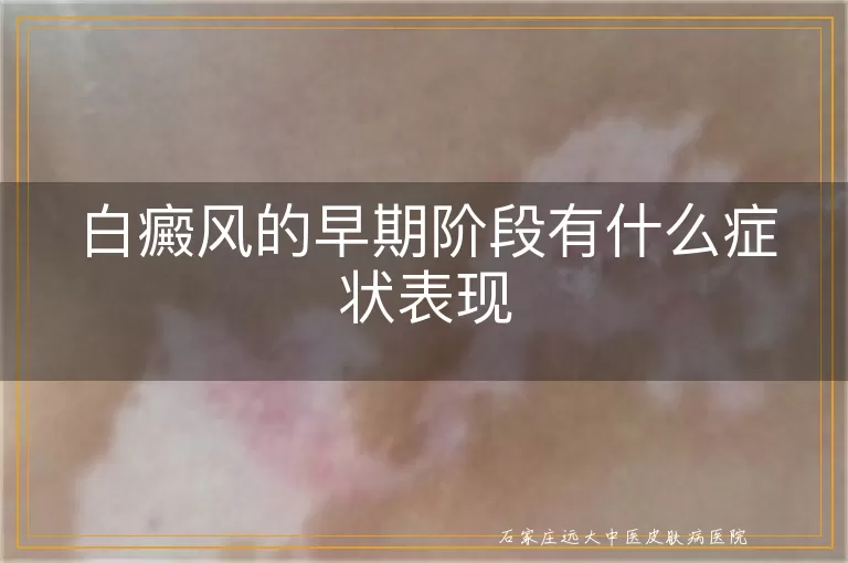 白癜风的早期阶段有什么症状表现