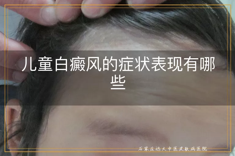 儿童白癜风的症状表现有哪些