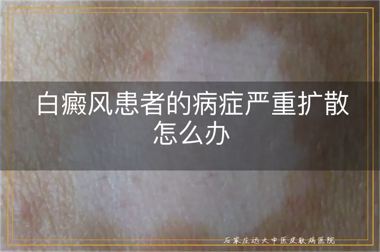 白癜风患者的病症严重扩散怎么办
