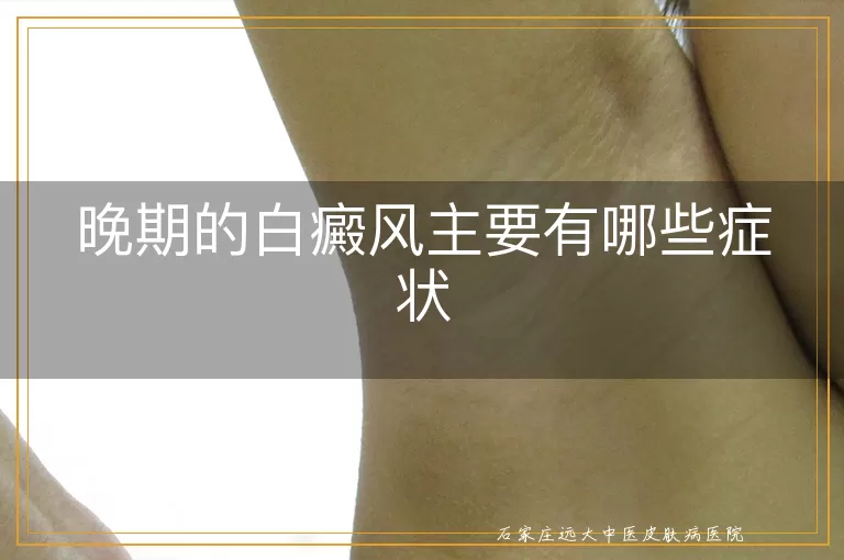 晚期的白癜风主要有哪些症状