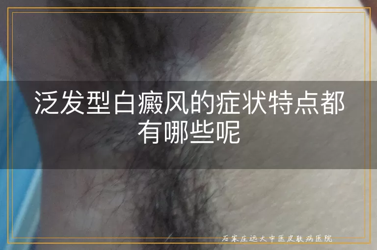 泛发型白癜风的症状特点都有哪些呢