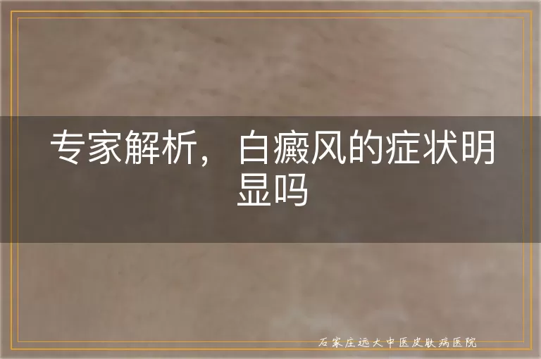 专家解析，白癜风的症状明显吗