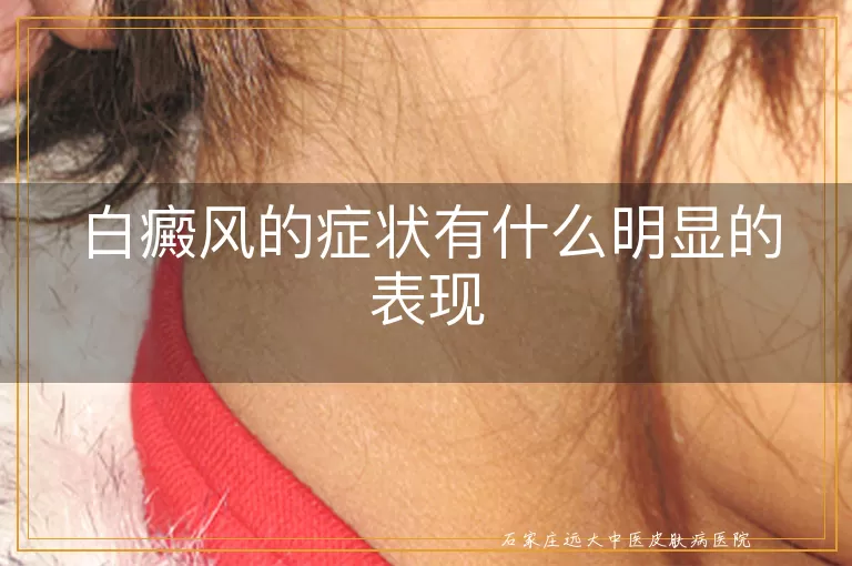 白癜风的症状有什么明显的表现