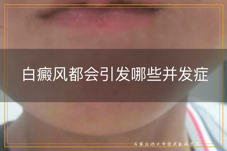 白癜风都会引发哪些并发症
