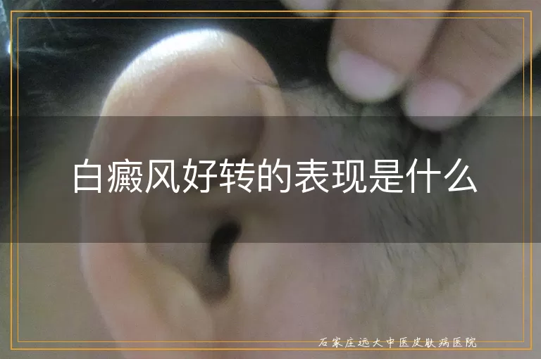 白癜风好转的表现是什么