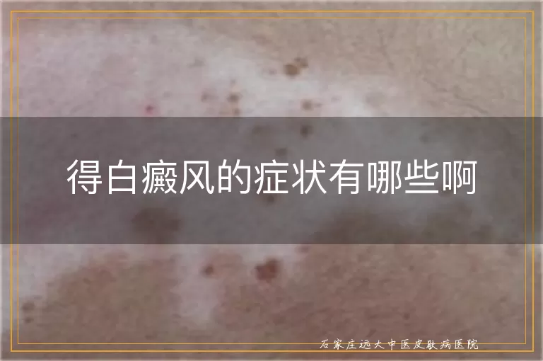 得白癜风的症状有哪些啊