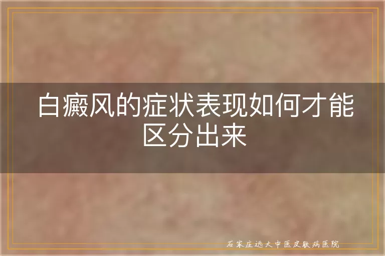 白癜风的症状表现如何才能区分出来
