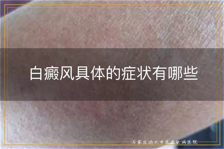 白癜风具体的症状有哪些